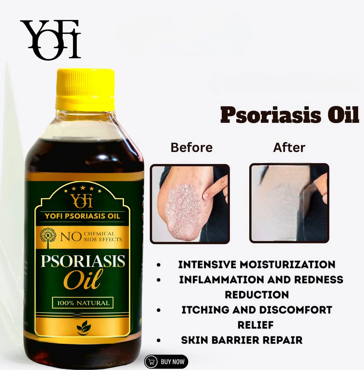 YOFI Psoriasis Relief Clean Oil – Soothing Natural Skin Therapy
