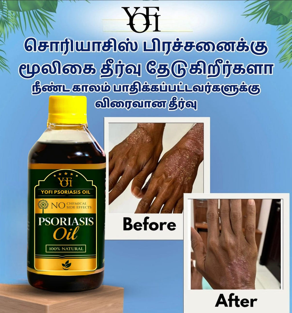 YOFI Psoriasis Relief Clean Oil – Soothing Natural Skin Therapy