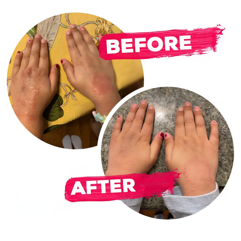YOFI Psoriasis Relief Clean Oil – Soothing Natural Skin Therapy