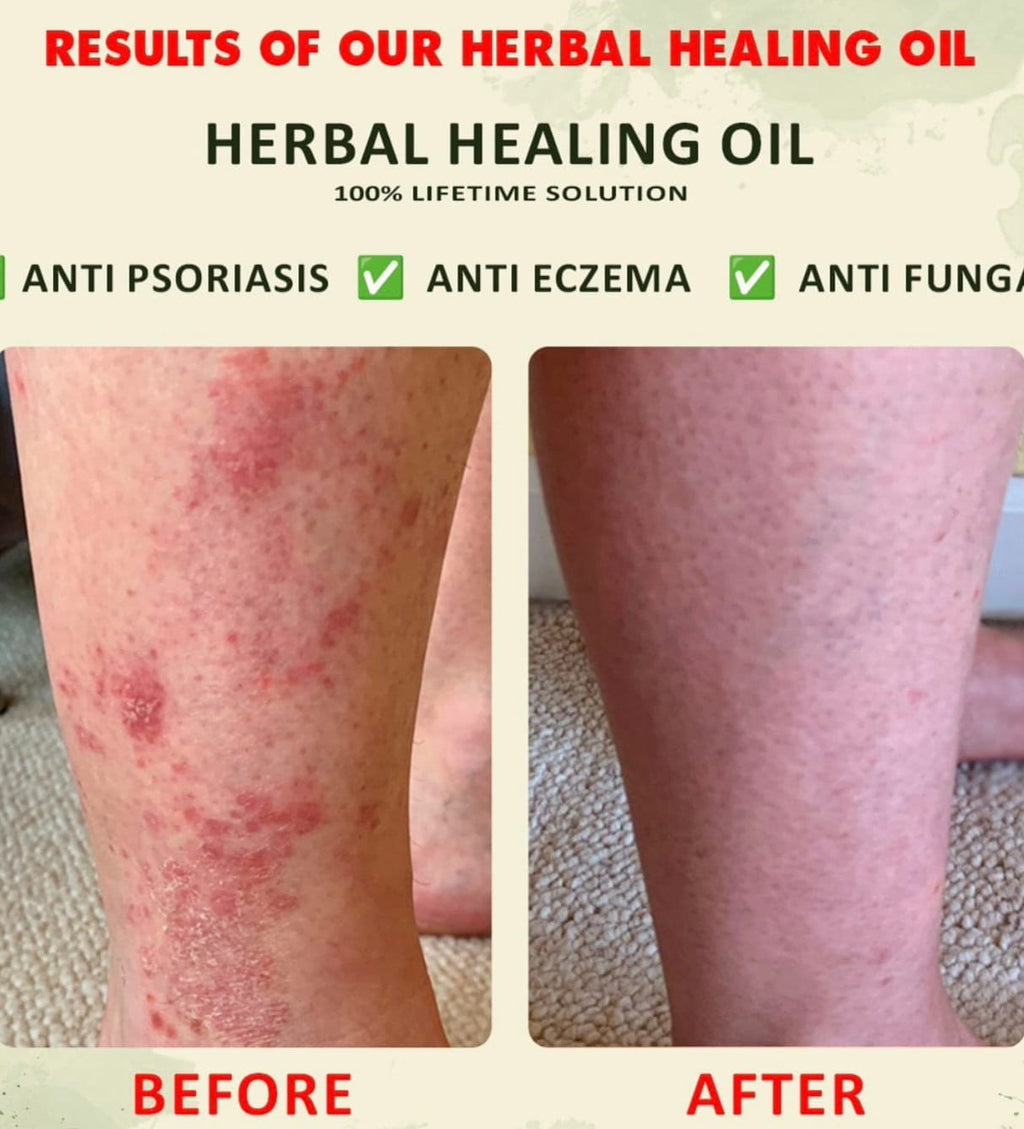 YOFI Psoriasis Relief Clean Oil – Soothing Natural Skin Therapy
