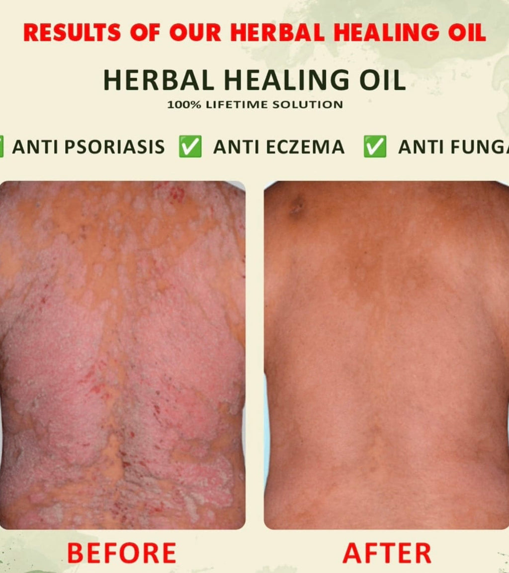 YOFI Psoriasis Relief Clean Oil – Soothing Natural Skin Therapy