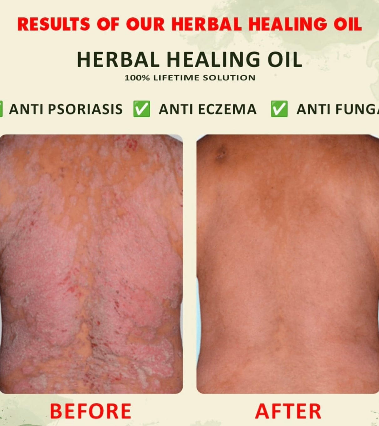 YOFI Psoriasis Relief Clean Oil – Soothing Natural Skin Therapy