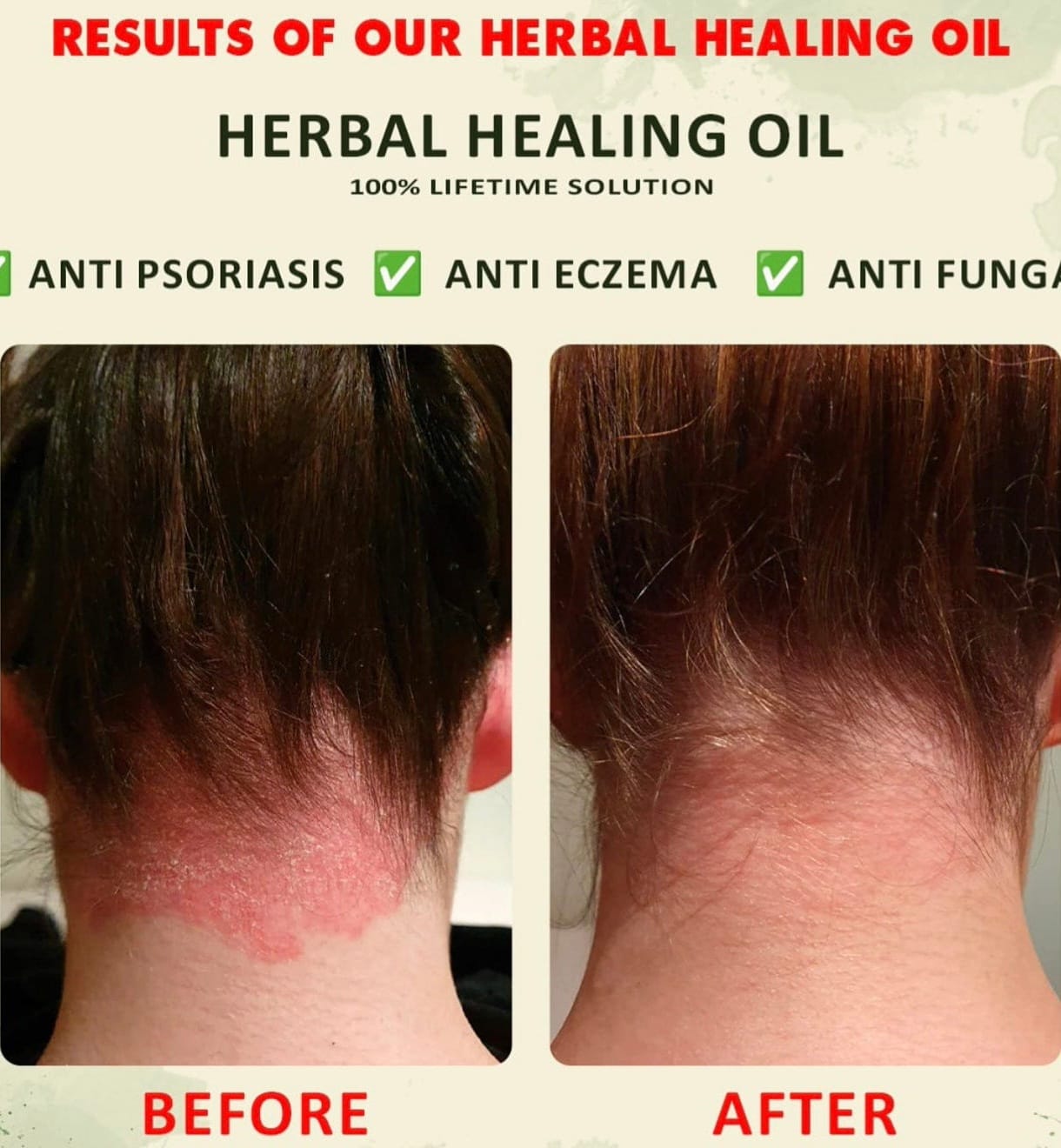 YOFI Psoriasis Relief Clean Oil – Soothing Natural Skin Therapy