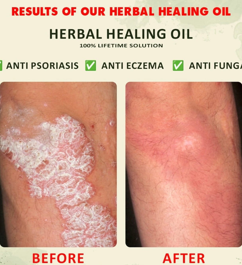 YOFI Psoriasis Relief Clean Oil – Soothing Natural Skin Therapy