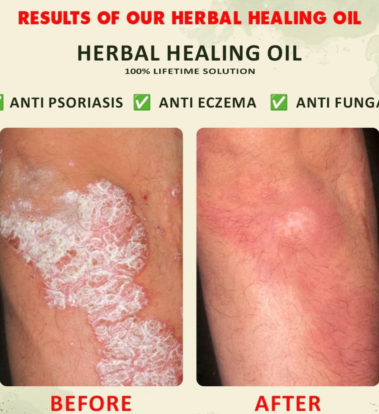 YOFI Psoriasis Relief Clean Oil – Soothing Natural Skin Therapy