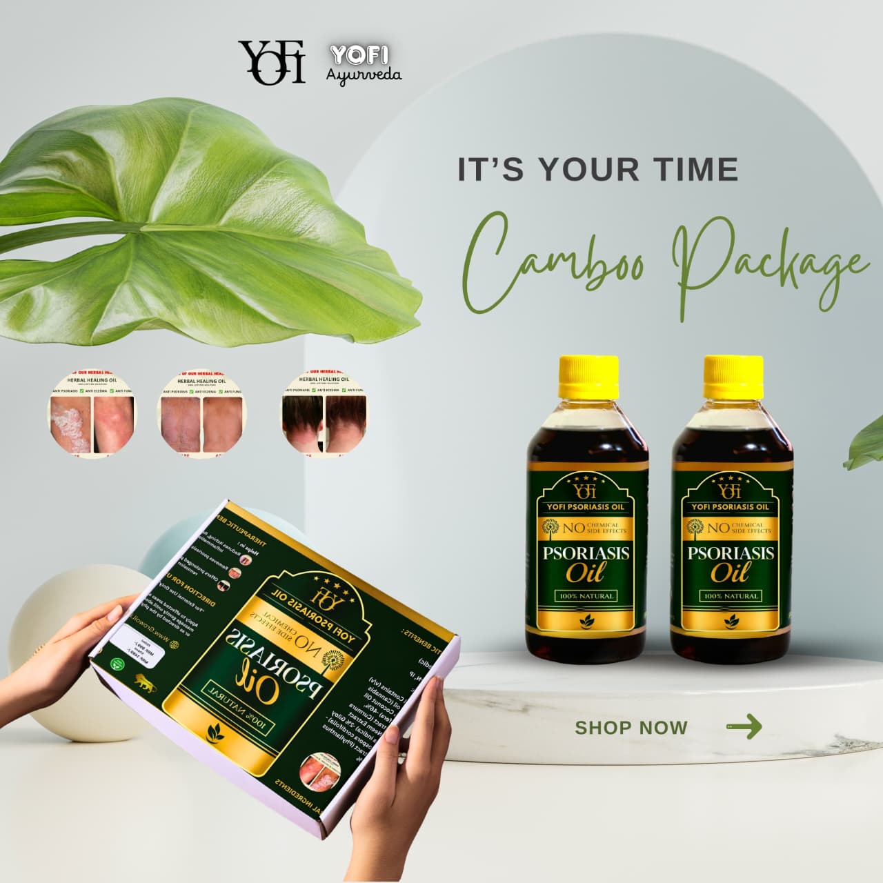 YOFI Psoriasis Relief Clean Oil – Soothing Natural Skin Therapy